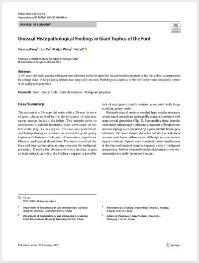 2025.2ɫεȹͬ׫¡Unusual Histopathological Findings in Giant Tophus of the Foot㲿޴ʹL(fng)ʯĮMW(xu)F(xin)SCIڿIndian Journal of Surgeryl(f).png